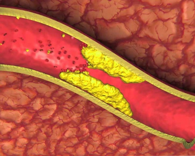 НАРОДНЫЕ СРЕДСТВА ЛЕЧЕНИЯ ДЛЯ СОСУДОВ ГОЛОВНОГО МОЗГА