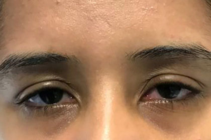 Жжение в глазах оказалось симптомом смертоносной болезни