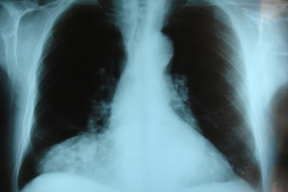 Редкую болезнь приняли за кишечную инфекцию и погубили ребенка