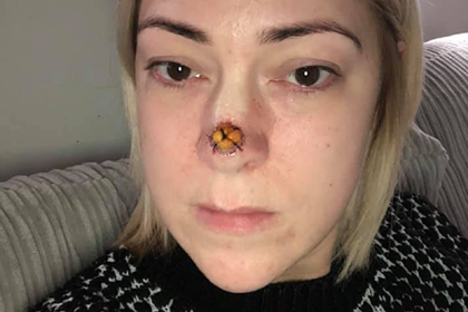 Маленькая точка на носу женщины оказалась раковой опухолью