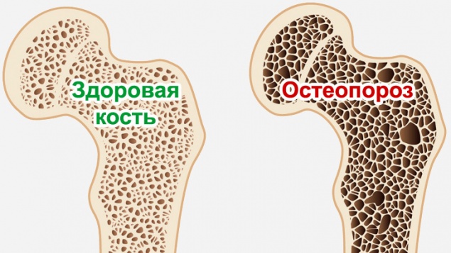 Ачинцев приглашают в Школу по борьбе с остеопорозом