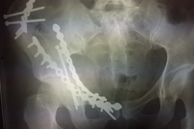 Как при серьезном ДТП: женщина раздробила таз при катании на плюшке и потеряла 1,5 литра крови