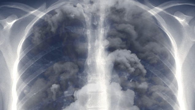 Врач рассказал о восстановлении легких бывших курильщиков