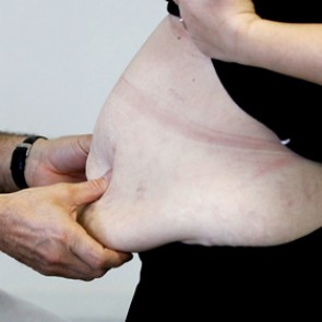 Ожирение обходится миру в 2 триллиона долларов в год