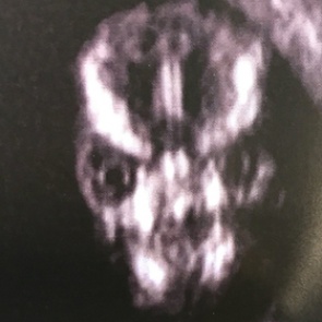 Нерожденный ребенок с лицом Волан-де-Морта напугал мать и ужаснул соцсети