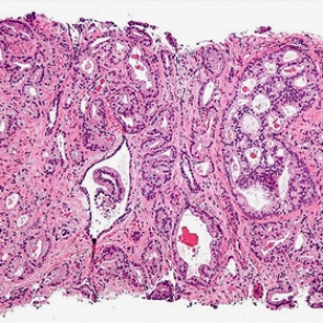 Названа причина особо опасного рака у мужчин