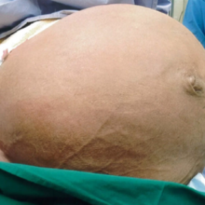 Вырастившая огромную опухоль женщина полгода терпела одышку из-за боязни врачей