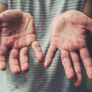 Корь: зачем делать прививку и какие сдавать анализы