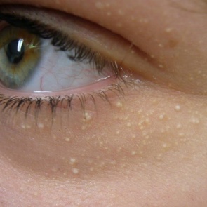 Как избавиться от просянки самостоятельно