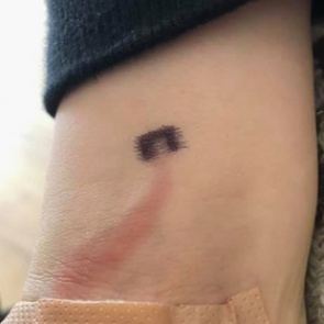 Мать заметила ссадину на руке сына и спасла ему жизнь