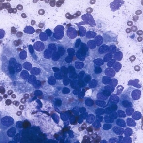 Ученые успешно протестировали новую терапию для лечения рака поджелудочной железы