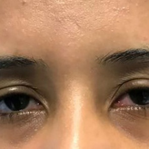 Жжение в глазах оказалось симптомом смертоносной болезни