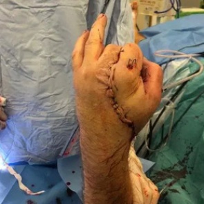 Отпиленную руку пришили к паху пациента