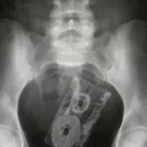 Доктора поделились снимками странных предметов внутри людей