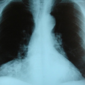 Редкую болезнь приняли за кишечную инфекцию и погубили ребенка