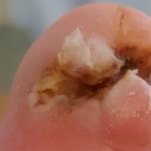 Женщина решила пробежать пять километров и лишилась ноги