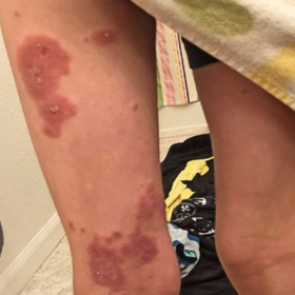 Врачи приняли смертельно опасное заболевание за аллергию на орехи