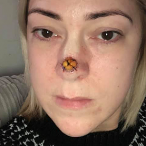 Маленькая точка на носу женщины оказалась раковой опухолью