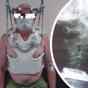 Мужчина упал со стремянки и через 2 недели пришел к врачам с головной болью. С такой травмой люди обычно умирают