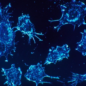 Раскрыта причина развития особо опасного рака