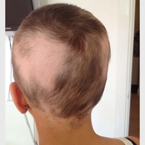 Женщина перепутала облысение с беременностью