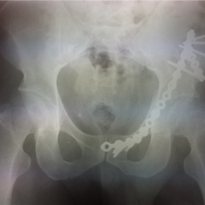 «Сопоставимо с травмами в ДТП»: травматологи красноярской БСМП показали последствия катания на «плюшке»