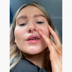 Студентка решила увеличить губы и едва их не потеряла